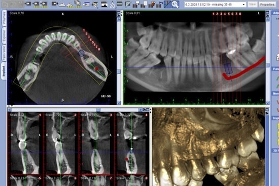 歯科用CTのメリット